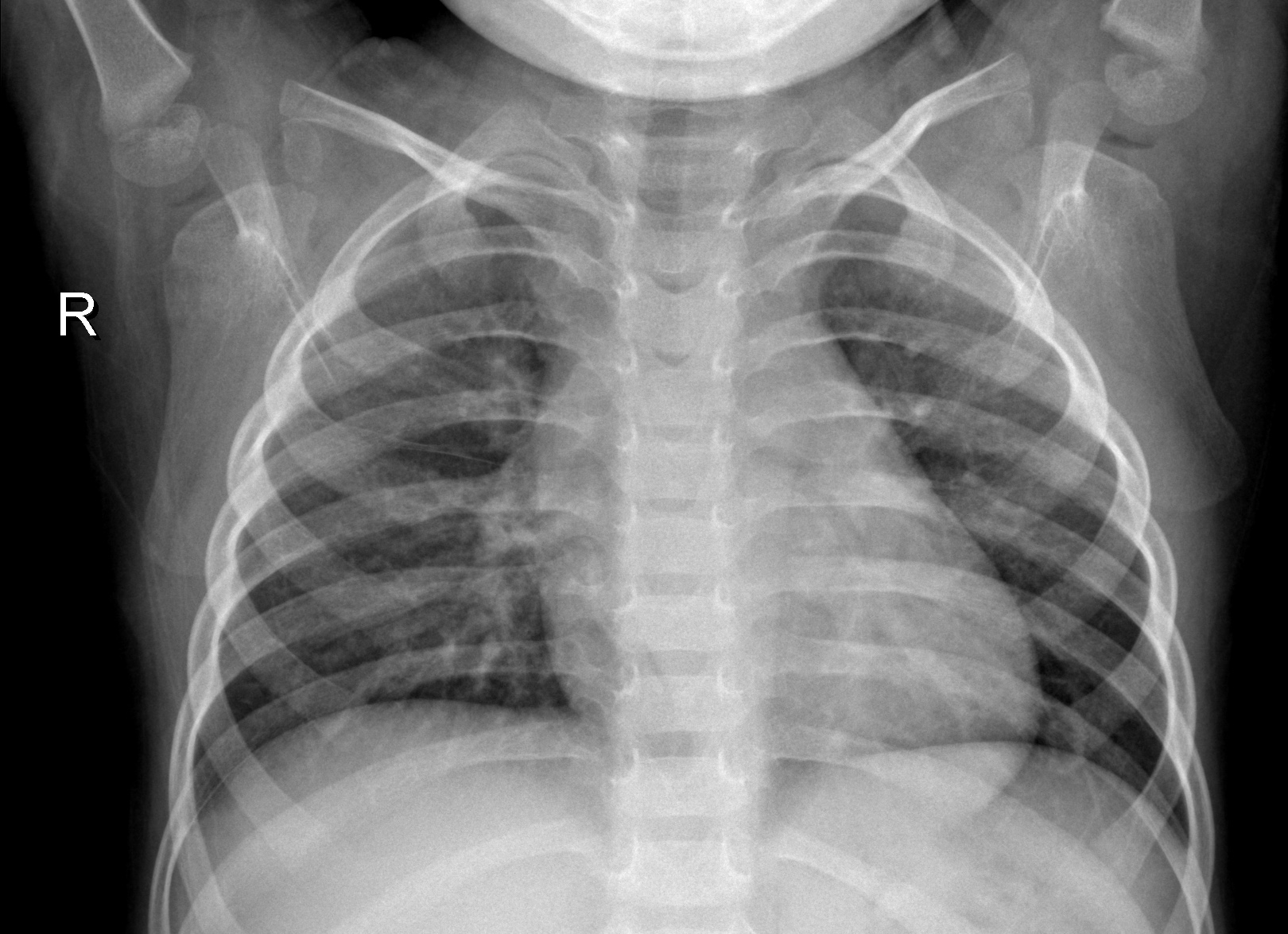 chest x-ray