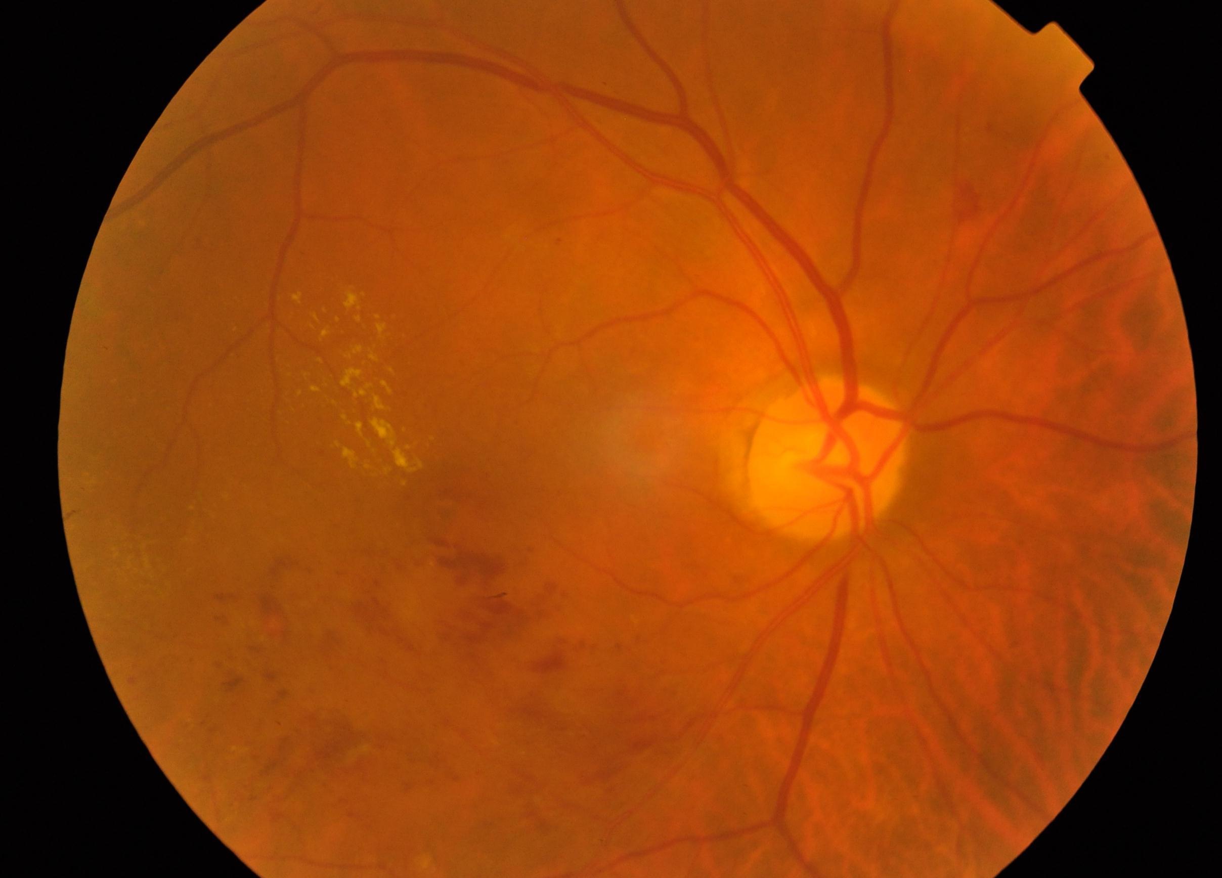fundus eye image
