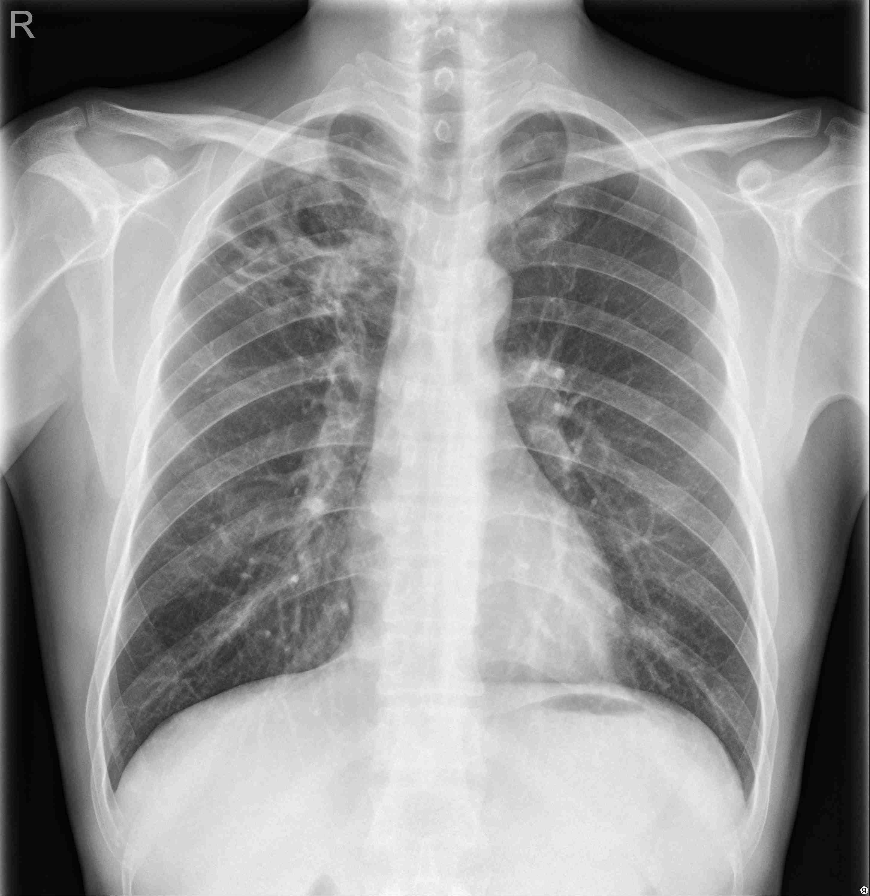 chest x-ray